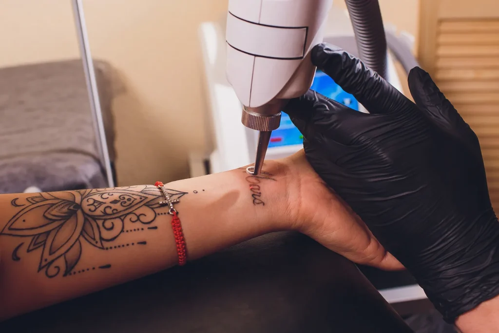 Tattoo removal procedure on forearm skin