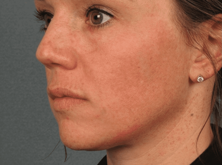 Chemical Peel before image
