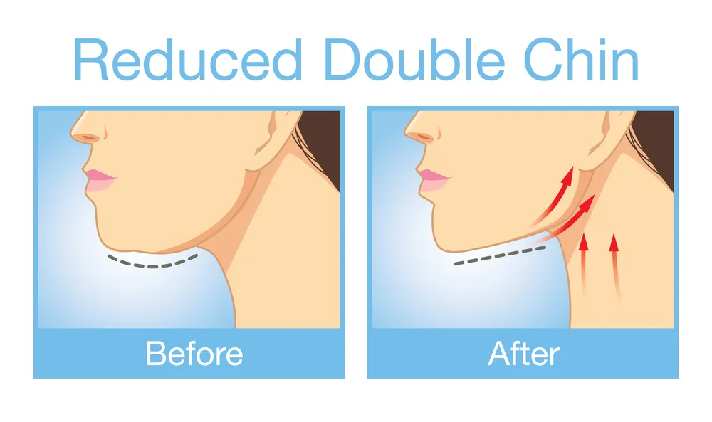 Double chin reduction before and after illustration
