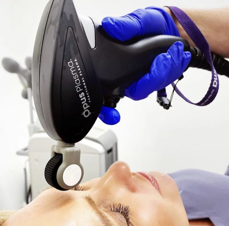 Skin resurfacing treatment with Opus Plasma device on forehead.