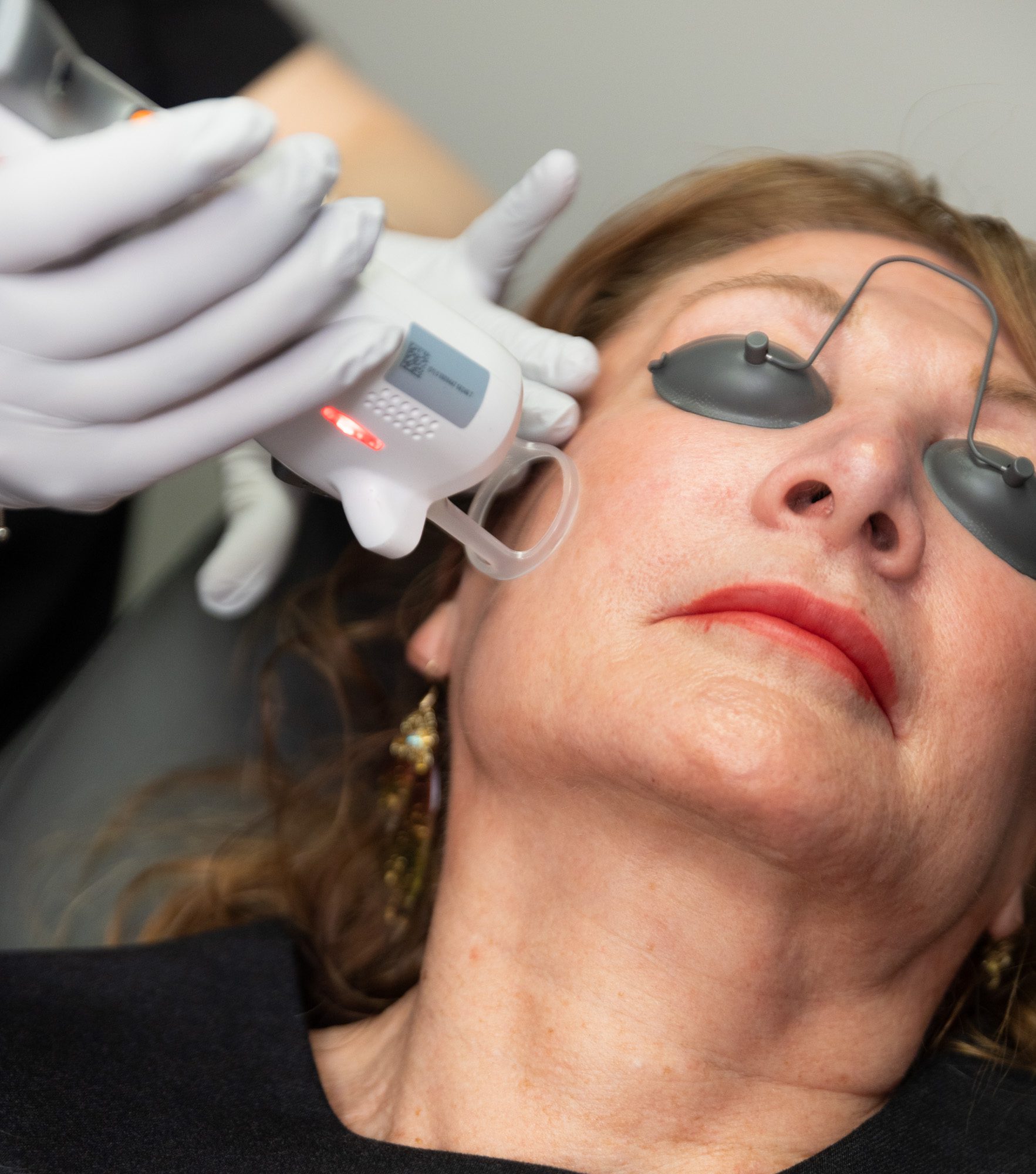 Woman undergoing laser skin rejuvenation treatment
