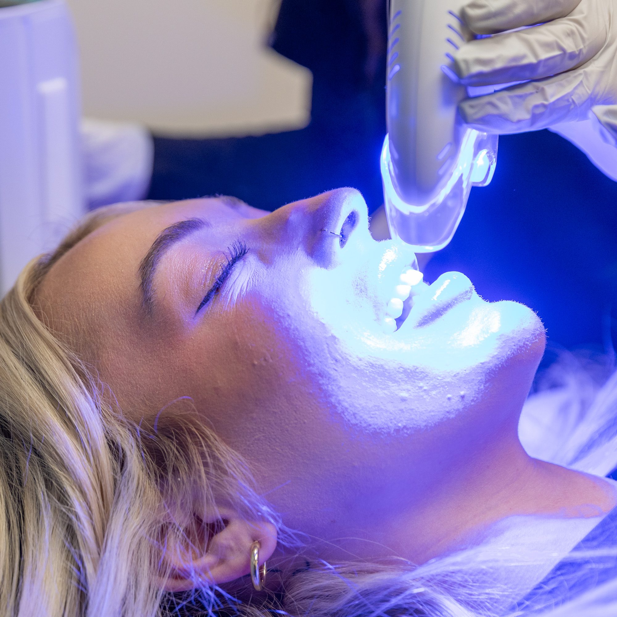 Teeth whitening procedure with blue light