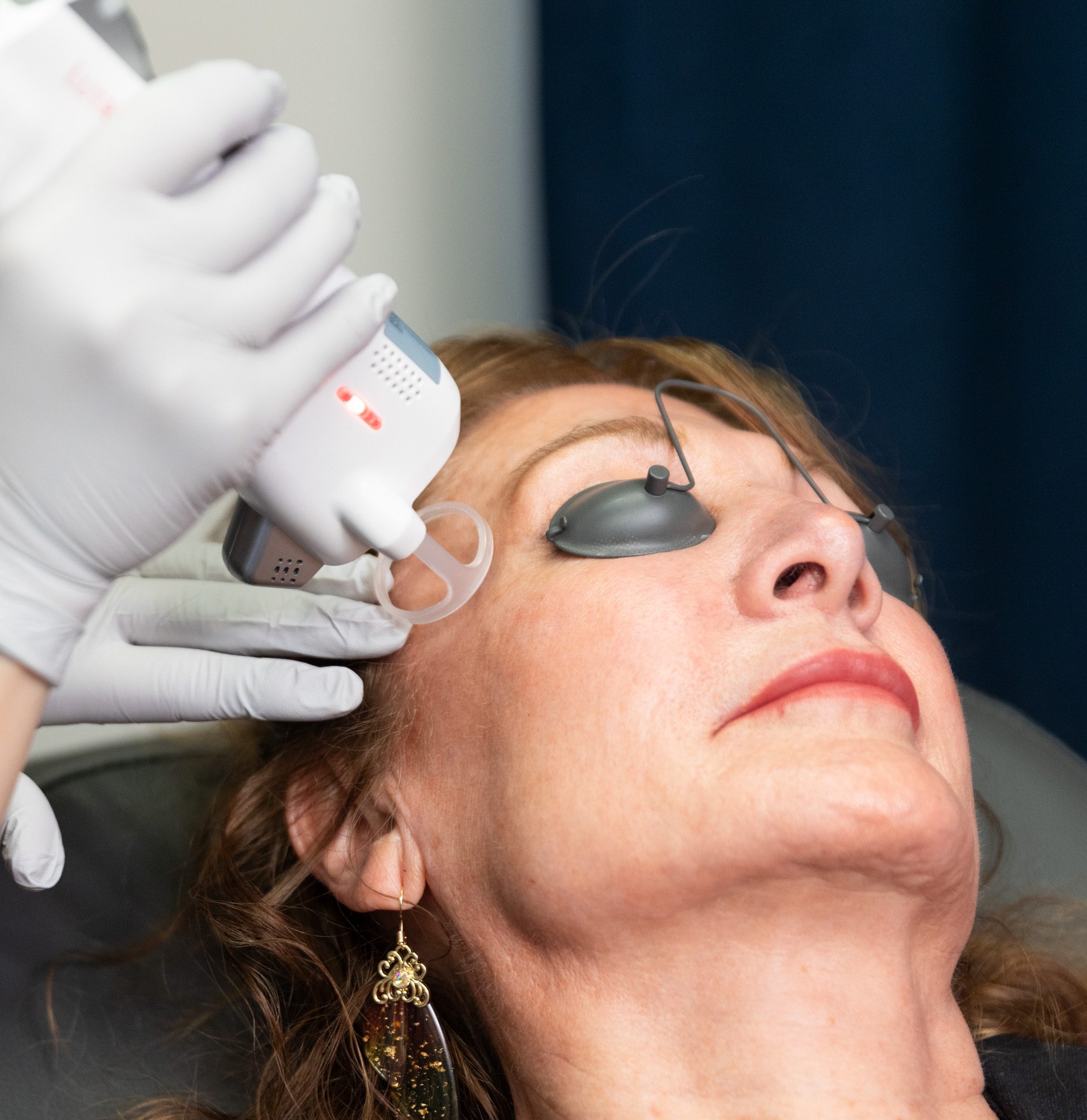 A woman is lying down with eye covers over her eyes as she receives treatment for acne scar removal at Xanadu Med Spa.