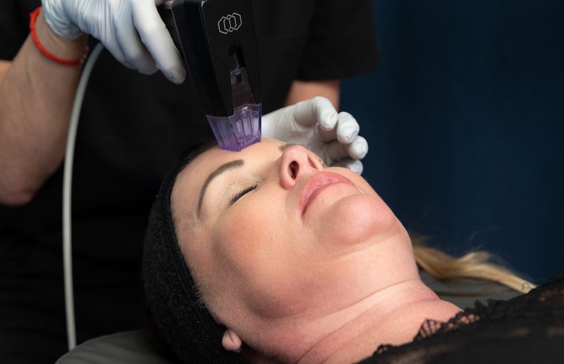 A woman is lying down for a Morpheus8 session after learning about Xanadu's acne scar treatment in Fort Collins.